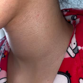 Lazer Epilasyon Seansları Hayal Kırıklığı Yarattı