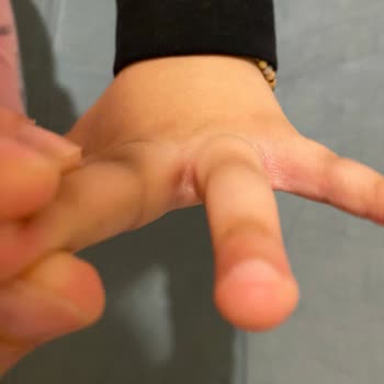 Dalin Köpük Sabun Kullanımı Sonrası Ciddi Alerjik Reaksiyonlar