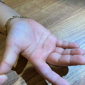 Dalin Köpük Sabun Kullanımı Sonrası Ciddi Alerjik Reaksiyonlar