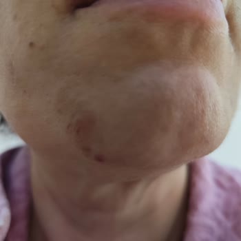 New Well Övülen Güneş Kremi Sivilce Sorunu Yarattı