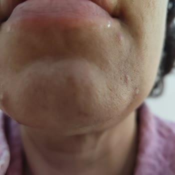 New Well Övülen Güneş Kremi Sivilce Sorunu Yarattı