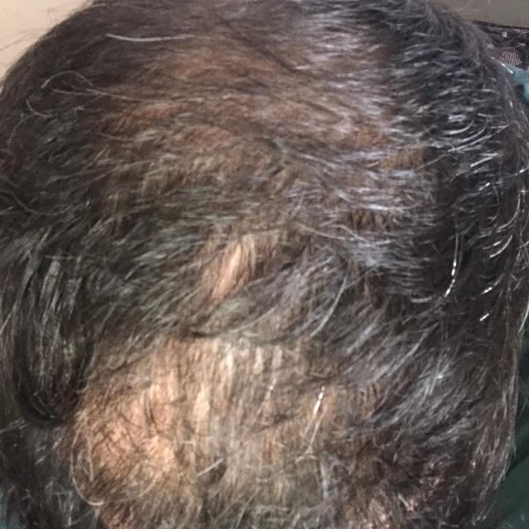 Sultan Özmen Hair Clinic Verdiğim Paradan Tam Olarak Verim Alamadım
