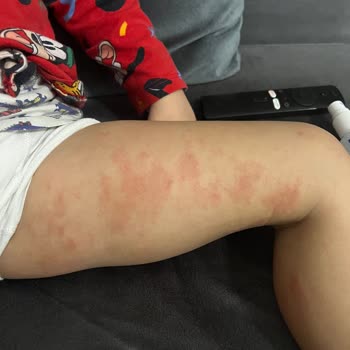 Mustela Stelatopia Ürünleri Çocuğumun Cildine Zarar Verdi!