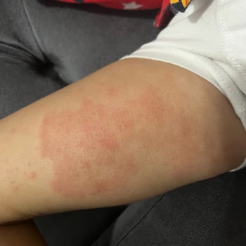 Mustela Stelatopia Ürünleri Çocuğumun Cildine Zarar Verdi!