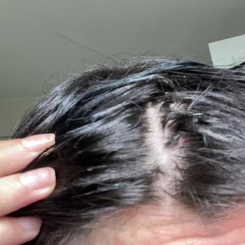 Sakarya Şahin Eroğlu Saç Kaynak Merkezi Hem Saçlarımız Kopuyor Hem Paramız Gidiyor!