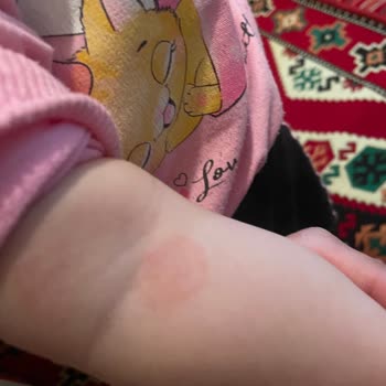 Mustela Kremi Bebeğimin Cildini Kötüleştirdi