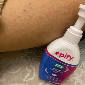 Epify Tüy Dökücü Kremden Kaynaklanan Cilt Sorunları