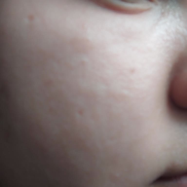 Gratis Ürün Alerjisi Ve Cilt Sorunları