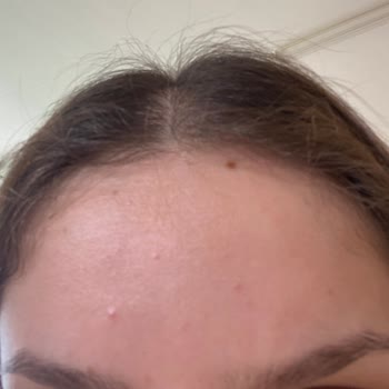 C Vitaminli Serum Cilt Sorunlarına Yol Açtı