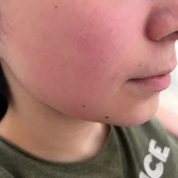 Hediye Ürün Ciltte Sorun Yarattı