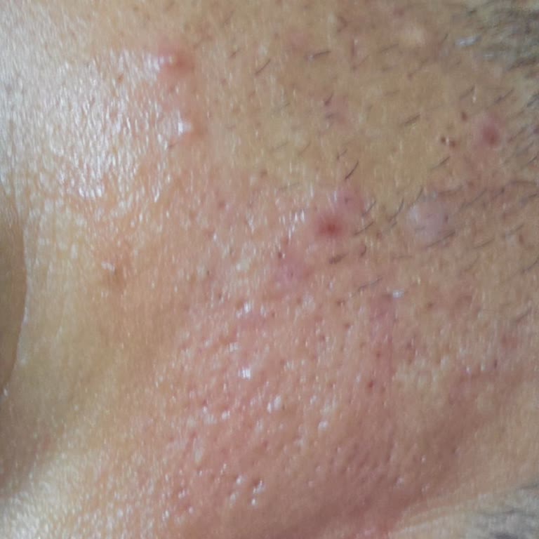 Güneş Kremi Ciltte Kızarıklık Yaptı