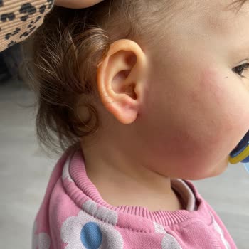 Bebek Cildi İçin Önerilen Ürün Tahrişe Sebep Oldu
