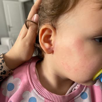 Bebek Cildi İçin Önerilen Ürün Tahrişe Sebep Oldu