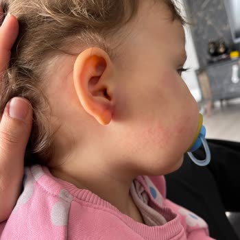 Bebek Cildi İçin Önerilen Ürün Tahrişe Sebep Oldu