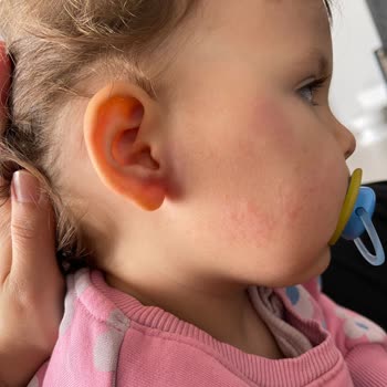 Bebek Cildi İçin Önerilen Ürün Tahrişe Sebep Oldu