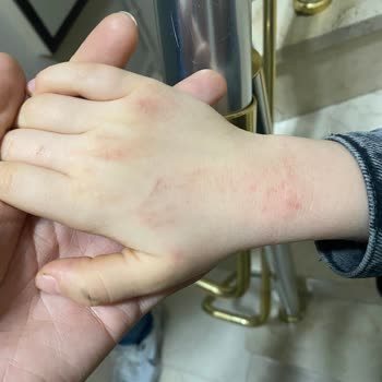 Oğlumun Ellerini Mahveden Ürün