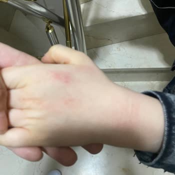 Oğlumun Ellerini Mahveden Ürün