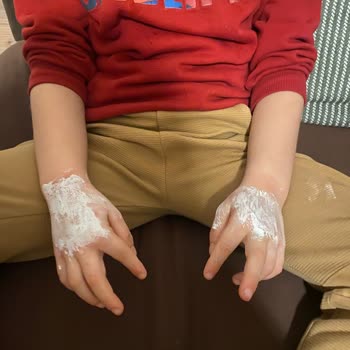 Oğlumun Ellerini Mahveden Ürün