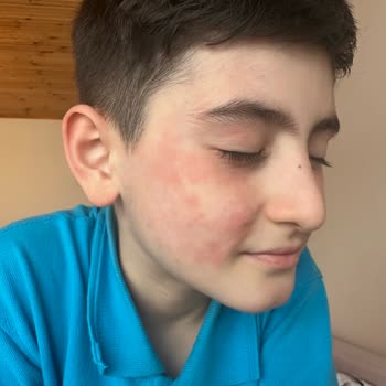 Nesquik Tüketimi Sonrası Alerjik Reaksiyon Şoku