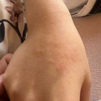 Nesquik Tüketimi Sonrası Alerjik Reaksiyon Şoku