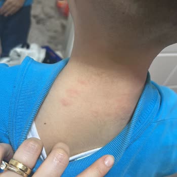 Nesquik Tüketimi Sonrası Alerjik Reaksiyon Şoku