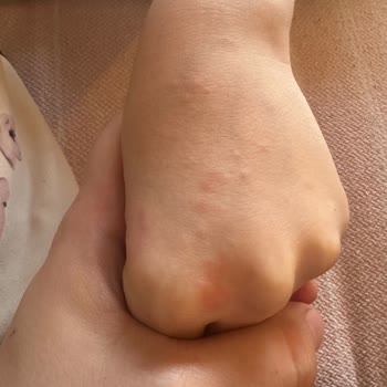 Nesquik Tüketimi Sonrası Alerjik Reaksiyon Şoku