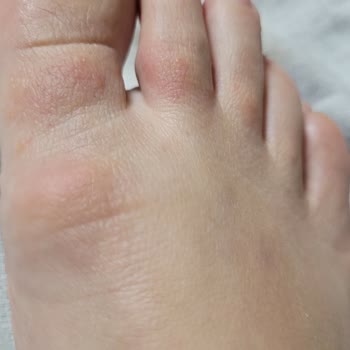 Alerji Ve Yara Yapan Ayakkabılarla Mağduriyet