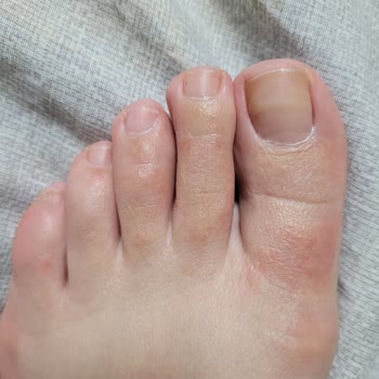 Alerji Ve Yara Yapan Ayakkabılarla Mağduriyet