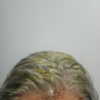 Saç Boyasında Beklenmedik Renk Ve Cilt Sorunu