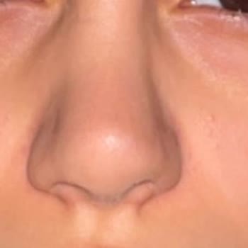 Estetik Ameliyat Kabusu: Genç Kadının Hayal Kırıklığı Ve Umutsuzluğu