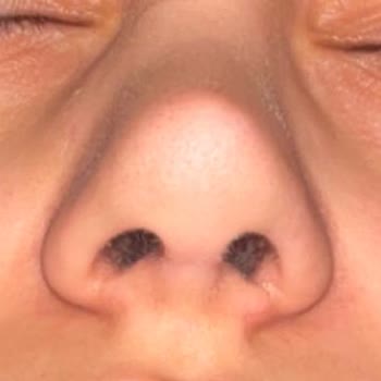 Estetik Ameliyat Kabusu: Genç Kadının Hayal Kırıklığı Ve Umutsuzluğu