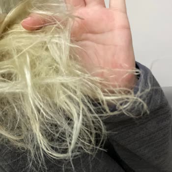 Morfose Saç Açıcı Kimyasal Yanık Ve Saç Kaybına Neden Oldu