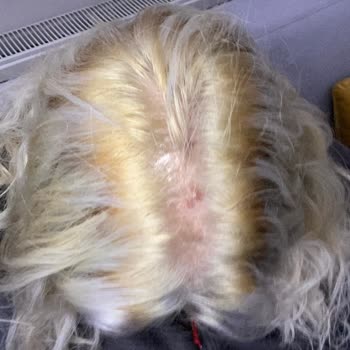 Morfose Saç Açıcı Kimyasal Yanık Ve Saç Kaybına Neden Oldu