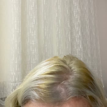 Morfose Saç Açıcı Kimyasal Yanık Ve Saç Kaybına Neden Oldu