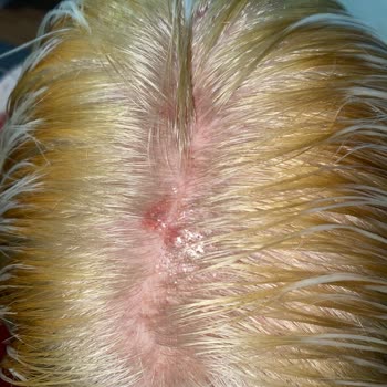 Morfose Saç Açıcı Kimyasal Yanık Ve Saç Kaybına Neden Oldu