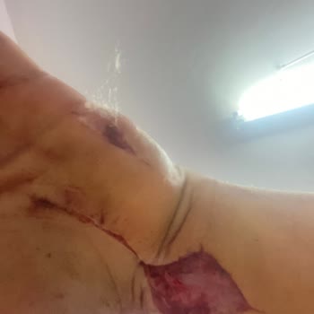 Yanlış Tedavi Sonucu Çekilen Acılar Ve Ameliyatlar