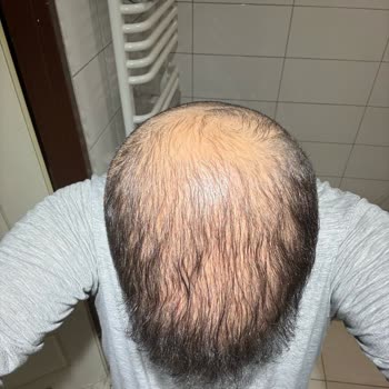 Aslı Tarcan Saç Ekim Merkezi'nde Hayal Kırıklığı