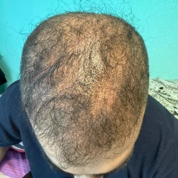 Aslı Tarcan Saç Ekim Merkezi'nde Hayal Kırıklığı