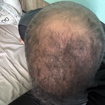 Aslı Tarcan Saç Ekim Merkezi'nde Hayal Kırıklığı