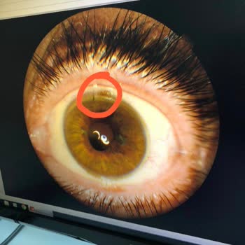 Göz Ameliyatında Unutulan Dikiş: Dedemin Sağlığı Tehlikede