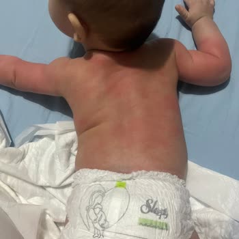 Mustela Ürünleri Bebeğimde Alerjik Reaksiyonlara Sebep Oldu