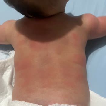 Mustela Ürünleri Bebeğimde Alerjik Reaksiyonlara Sebep Oldu