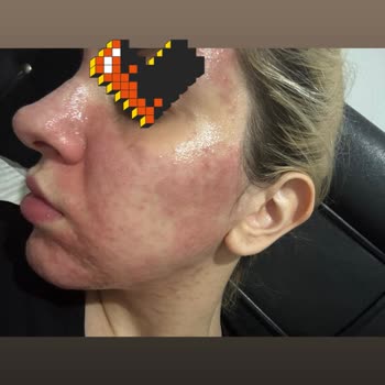 Yanlış Tedavi Sonucu Yüzde Yanık Ve İletişim Sorunu