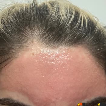 Yanlış Tedavi Sonucu Yüzde Yanık Ve İletişim Sorunu