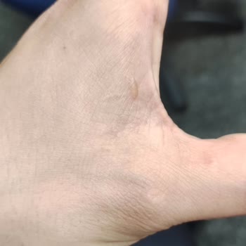 Veet Tüy Dökücü Krem Kullanımı Sonrası Ciddi Alerjik Reaksiyon