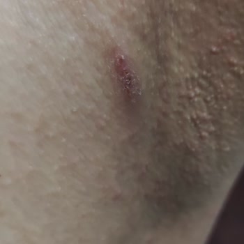 Veet Tüy Dökücü Krem Kullanımı Sonrası Ciddi Alerjik Reaksiyon