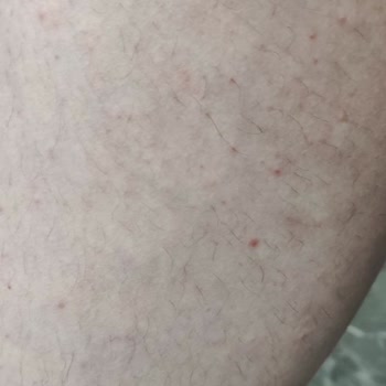 Veet Tüy Dökücü Krem Kullanımı Sonrası Ciddi Alerjik Reaksiyon