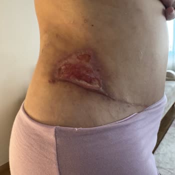 Ameliyat Sonrası Memnuniyetsizlik: İlgisiz Doktor Ve Kalıcı İzler