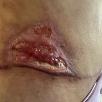 Ameliyat Sonrası Memnuniyetsizlik: İlgisiz Doktor Ve Kalıcı İzler