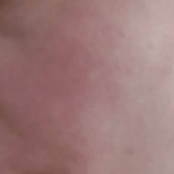 Güvenilir Marka Hayal Kırıklığı: Cilt Sorunları